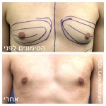 ניתוח גניקומסטיה ד"ר לוי אברהם