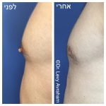 גניקומסטיה הקטנת חזה לגבר