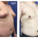 הקטנת חזה לגבר גניקומסטיה