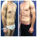 גניקומסטיה לפני ואחרי