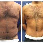 גניקומסטיה לפני ואחרי