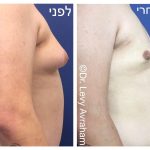 גניקומסטיה לפני ואחרי