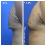 גניקומסטיה לפני ואחרי