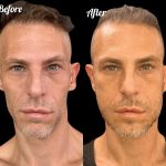 ניתוח לסת לגבר