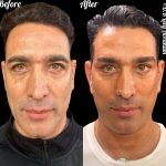 עיצוב קו לסת