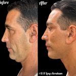 עיצוב קו לסת