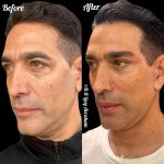 עיצוב קו לסת