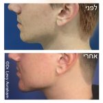 ניתוח לעיצוב קו לסת