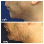 עיצוב קו לסת לגבר