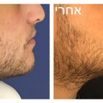 עיצוב קו לסת בניתוח