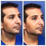 פיסול ועיצוב קו לסת