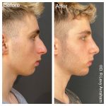 פיסול קו לסת