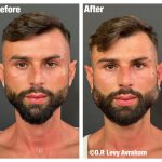 ניתוח קו לסת